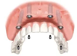 Técnica All-on-4 · Arcada fixa sobre 4 implantes