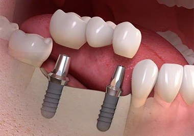 Implantes dentários múltiplos com ponte fixa sobre vários implantes