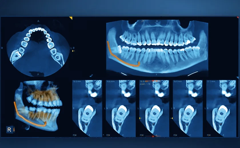 Imagens de CBCT 3D: cortes axiais, vista panorâmica e reconstrução 3D