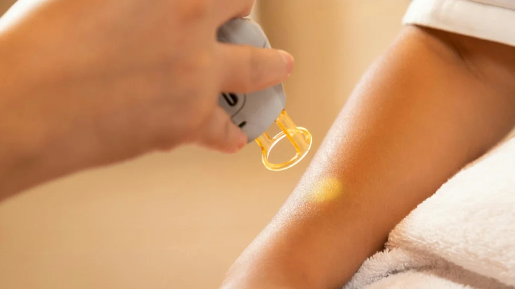 Depilação a laser em braço.