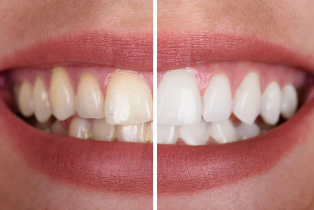 Dentes amarelados e com imperfeições ao lado de dentes brancos e uniformes.