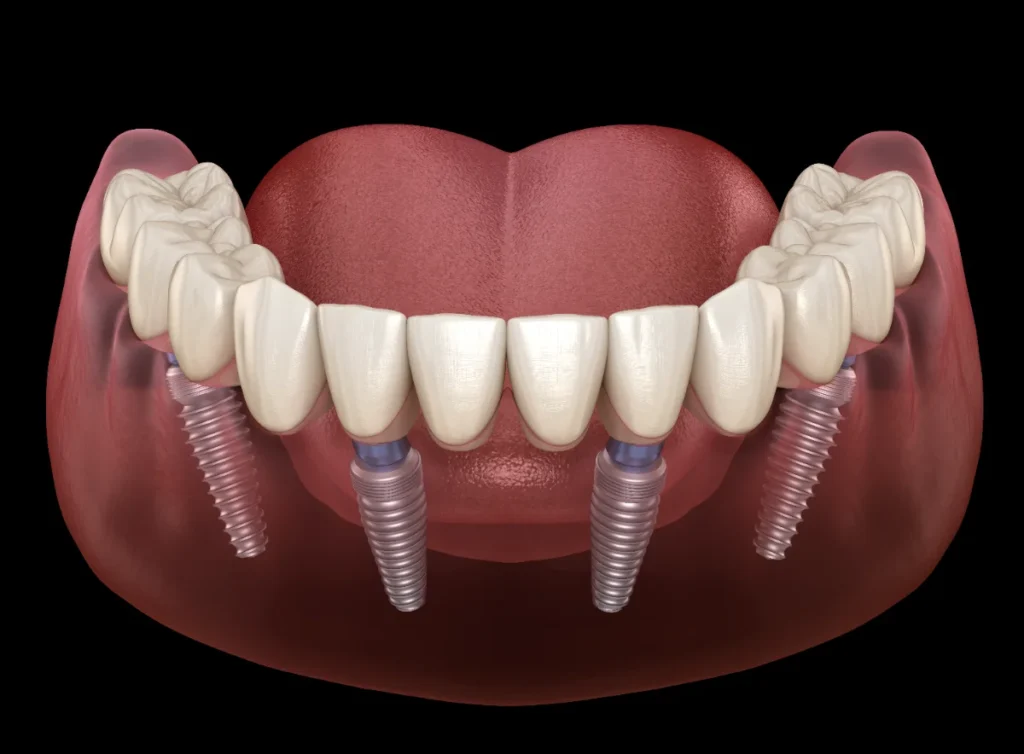 Implantes dentários com coroas dentárias fixas.