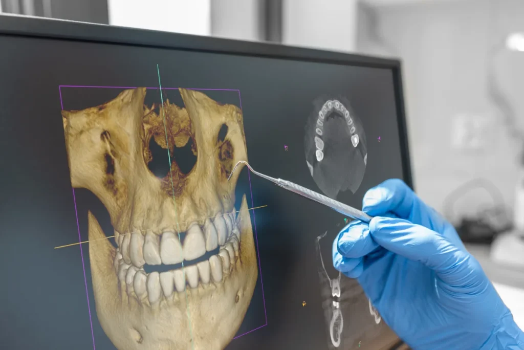 Mão com luva azul segura instrumento junto a monitor com imagem de mandíbula e radiografia.