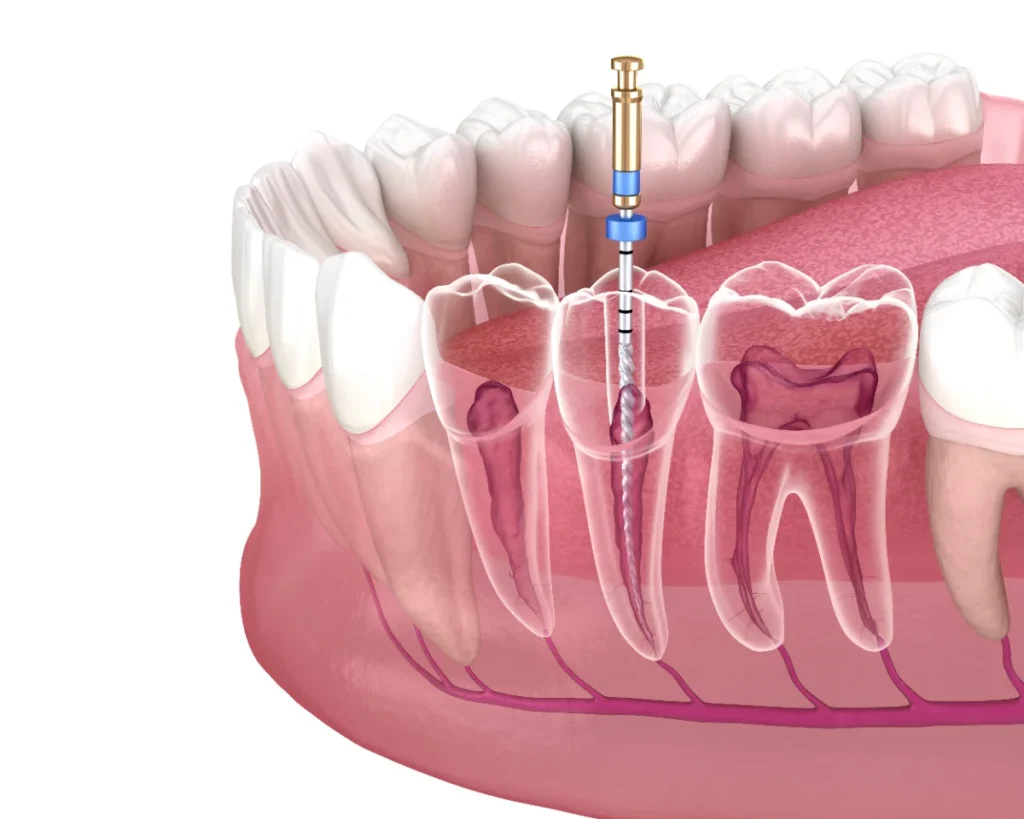 Ilustração de um procedimento de endodontia, com um dente sendo tratado com uma broca.