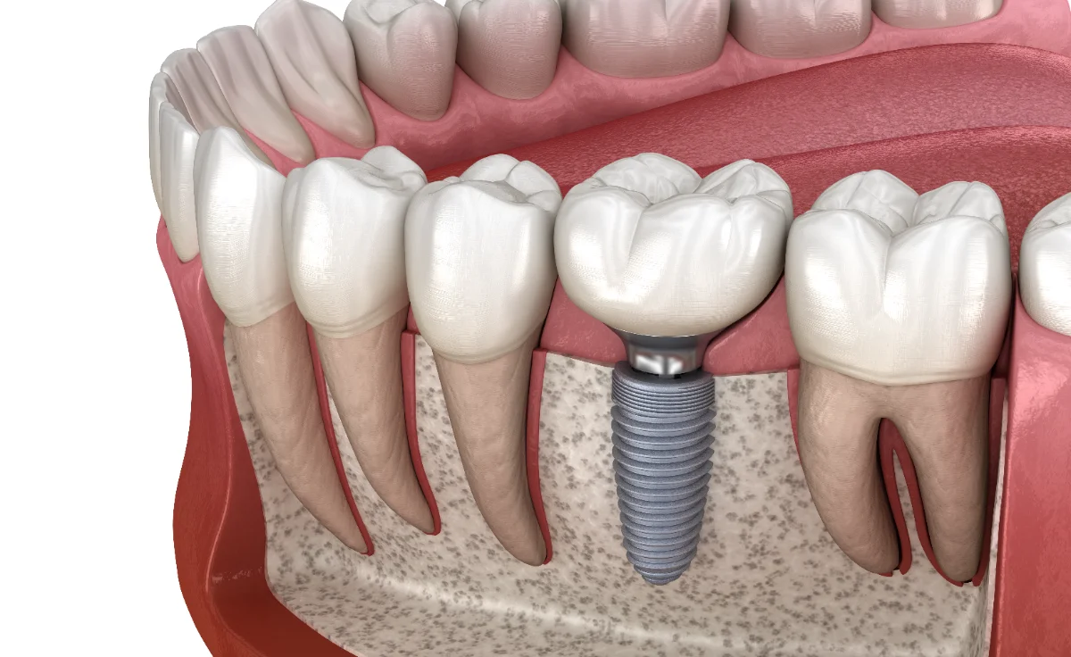Ilustração de um implante dentário com coroa, fixo no osso entre dois dentes naturais
