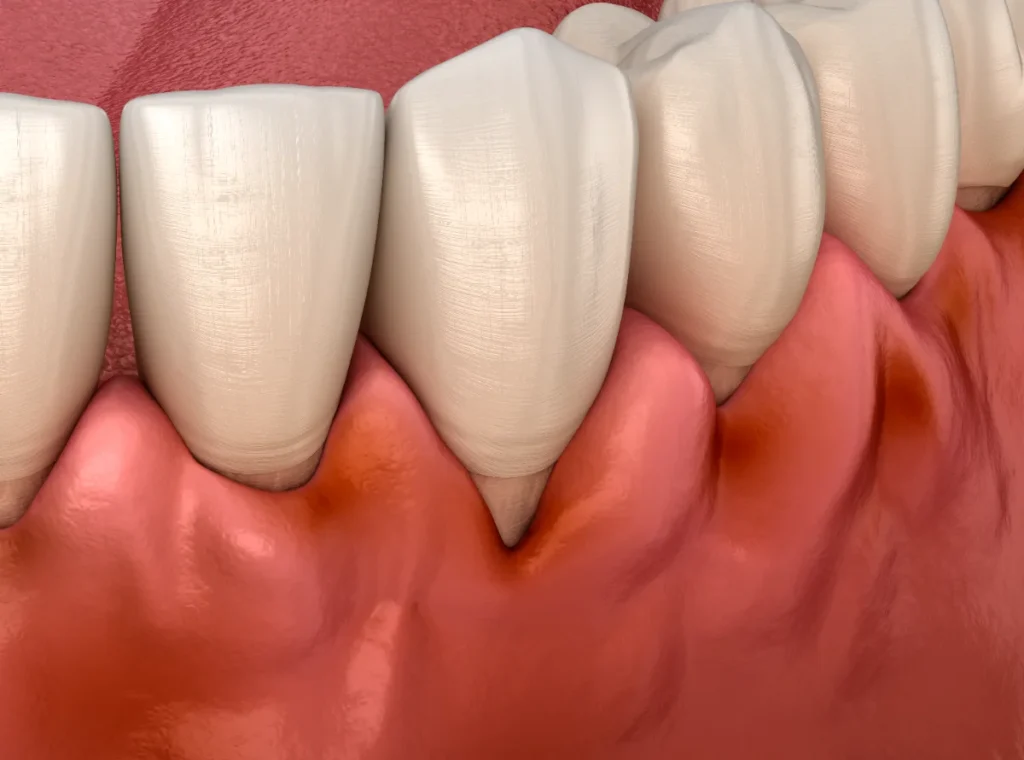 Dentes com recessão gengival, ilustração 3D de problema de saúde oral.