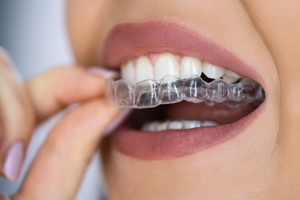 Mulher a colocar alinhador transparente nos dentes.