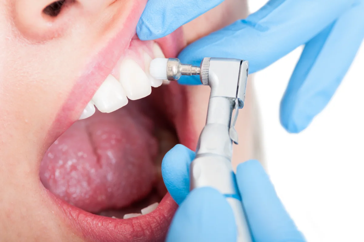 Paciente com a boca aberta durante procedimento de limpeza ou exame dentário.