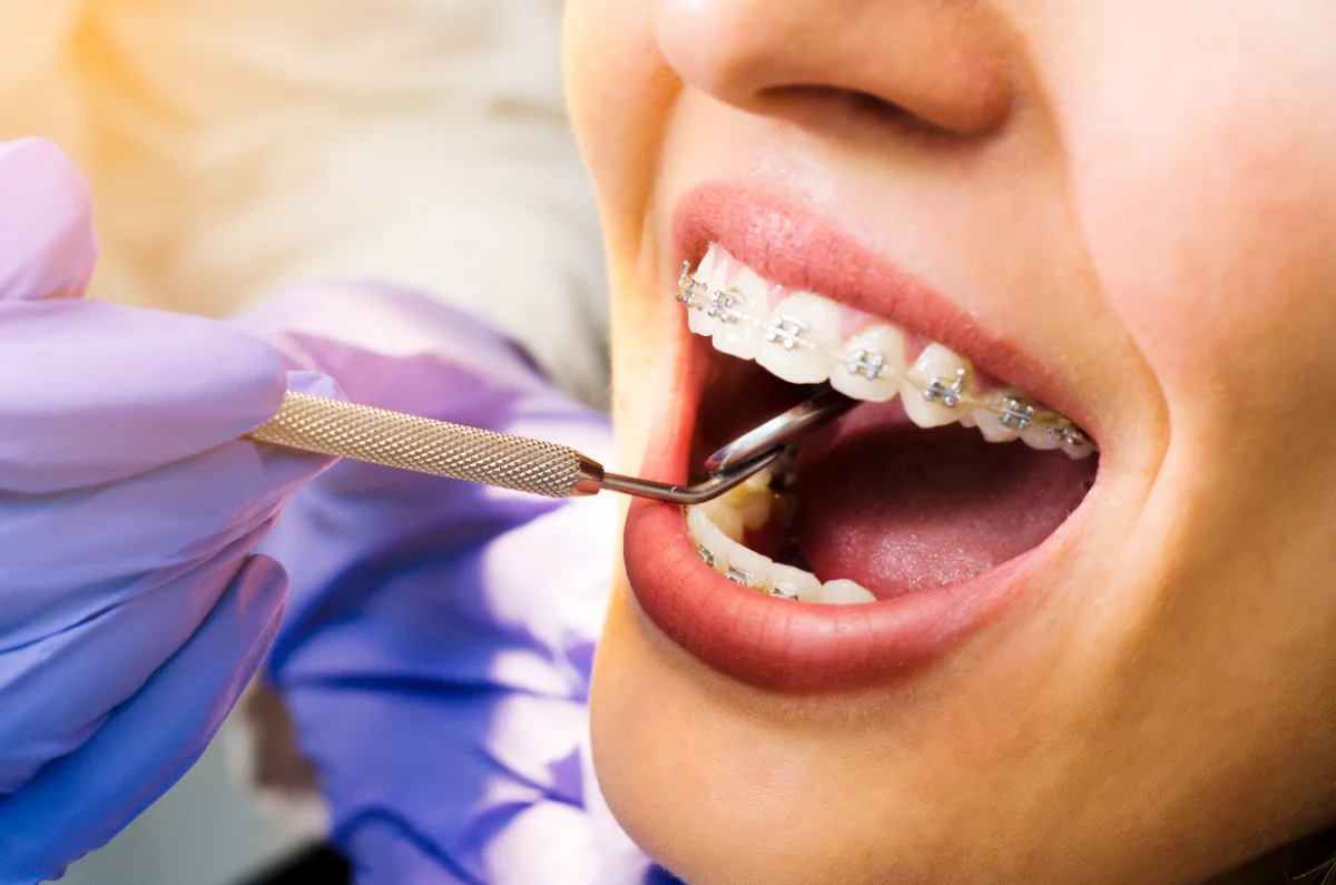 Paciente com aparelho dentário a ser examinado por um profissional de saúde oral.