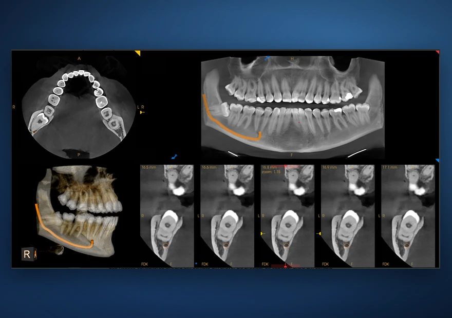 Exame CBCT 3D no software: vistas axial, panorâmica e reconstrução tridimensional