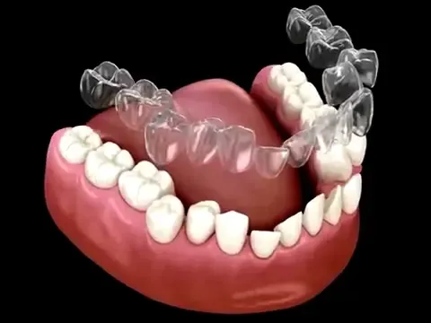 Animação 3D da colocação de um alinhador transparente nos dentes
