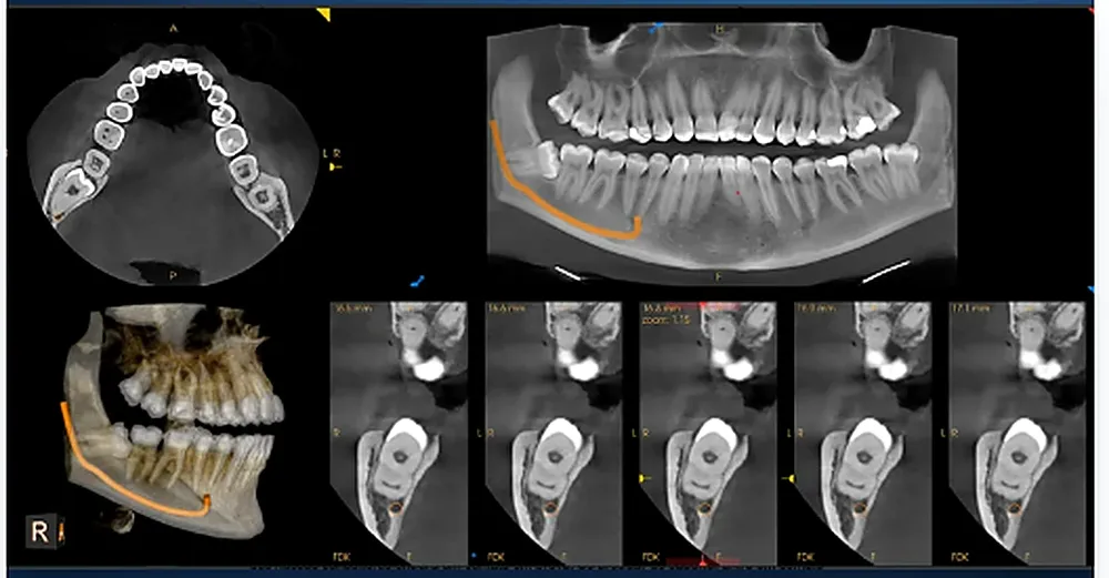 Exame CBCT 3D: cortes axial, panorâmico, reconstrução 3D e cortes transversais com o trajeto do nervo marcado