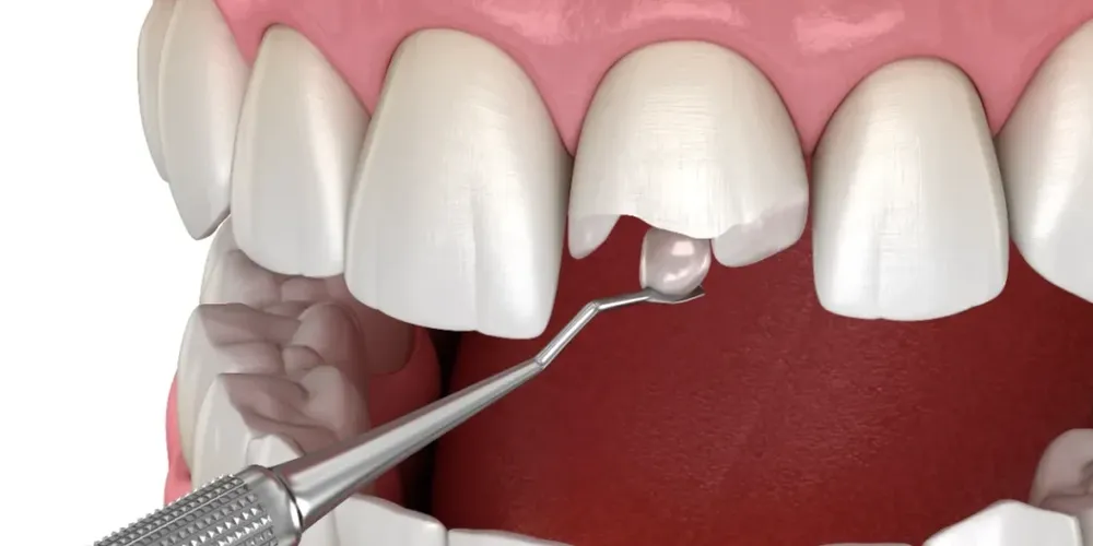 Ilustração da restauração de um dente incisivo partido