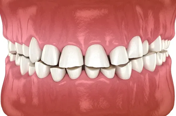 Ilustração de dentes desgastados pelo bruxismo