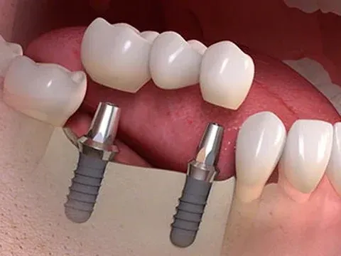 Ilustração de ponte sobre dois implantes