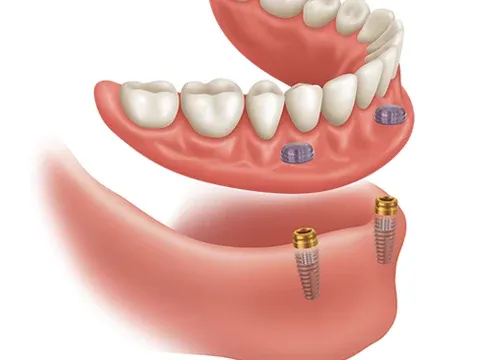 Ilustração de sobredentadura inferior que encaixa em dois implantes