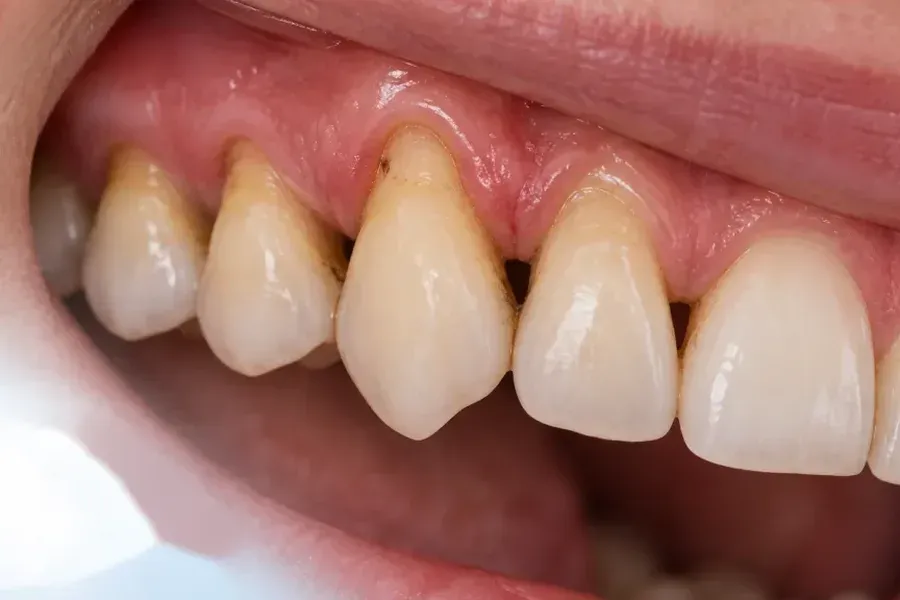 Periodontite: sintomas, causas e como proteger os seus dentes