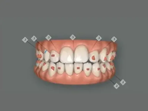 Plano digital Smile Aligners Lusocare: vista frontal com os encaixes marcados nos dentes