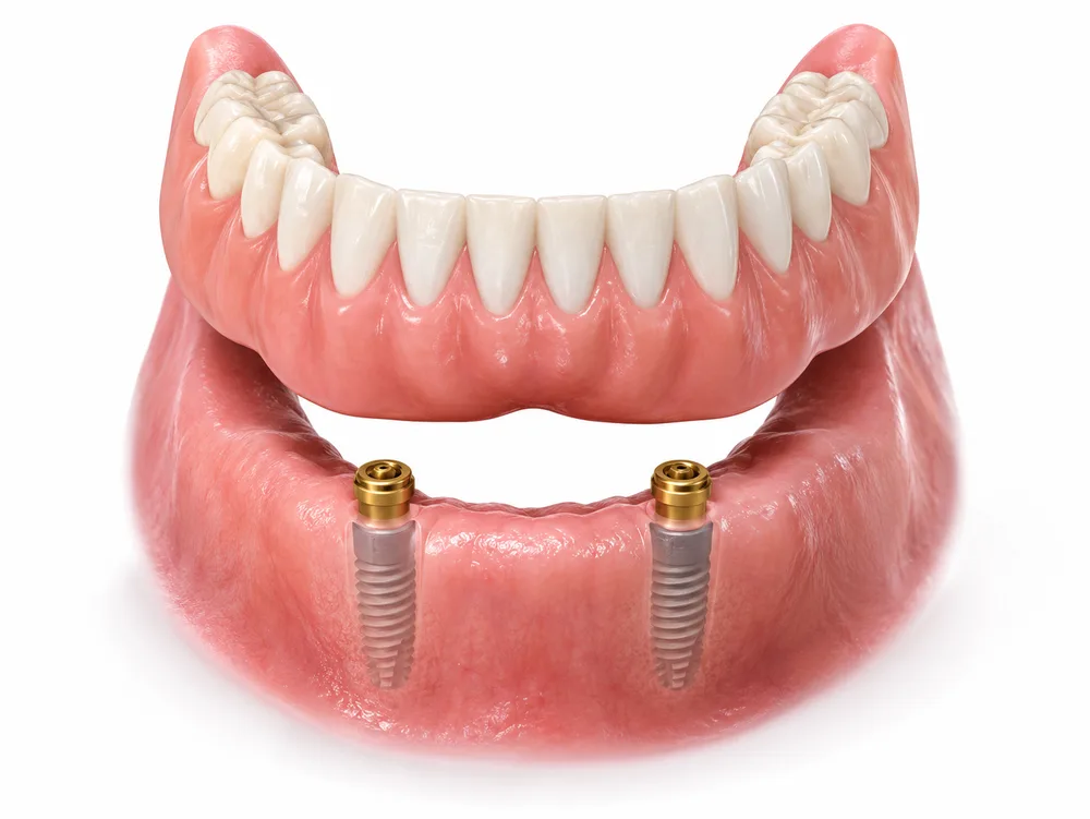 Ilustração de prótese removível que encaixa em dois implantes no maxilar inferior (sobredentadura)