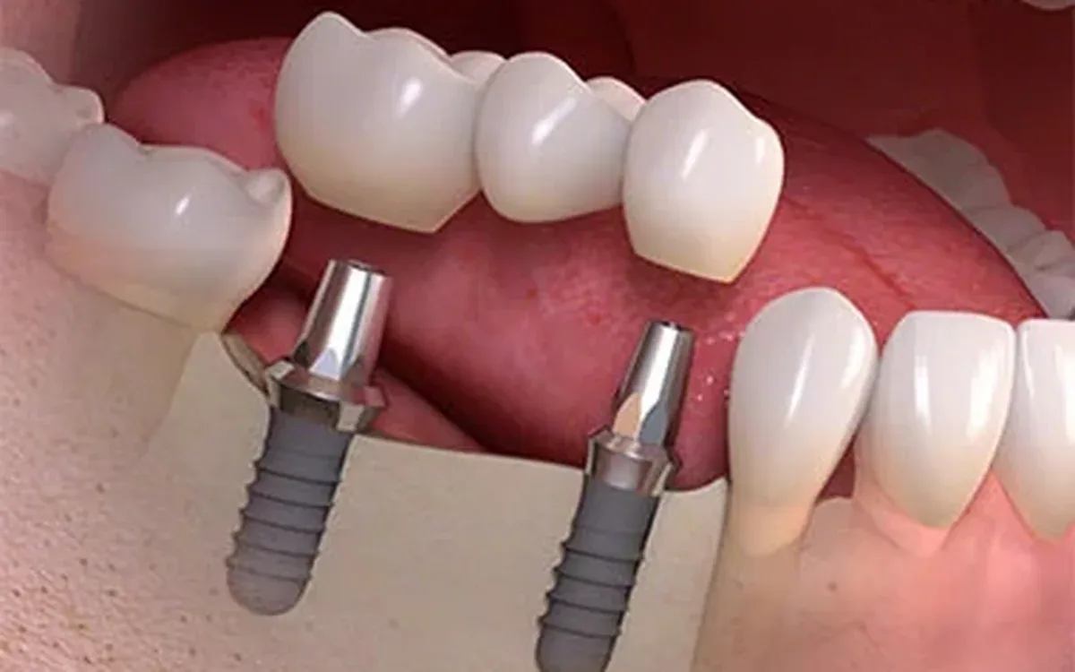Ilustração de uma ponte de três dentes fixa sobre dois implantes dentários